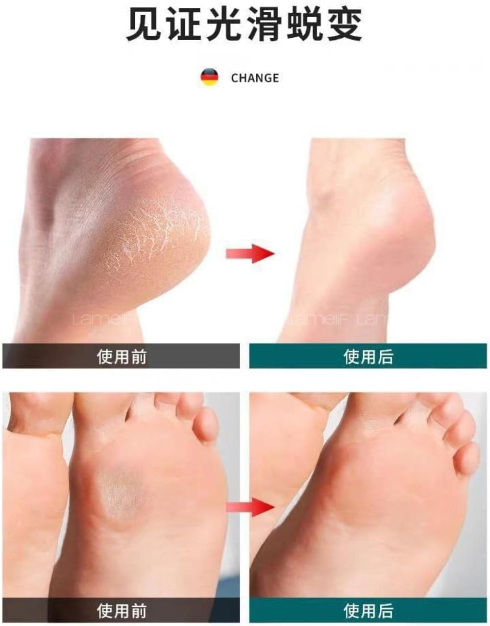 Lamelif Saplı Epilatör Tüy Dökücü